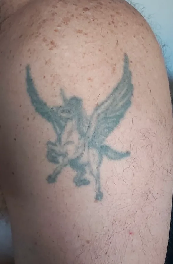 Cover-up de tatuaje en Madrid — antes