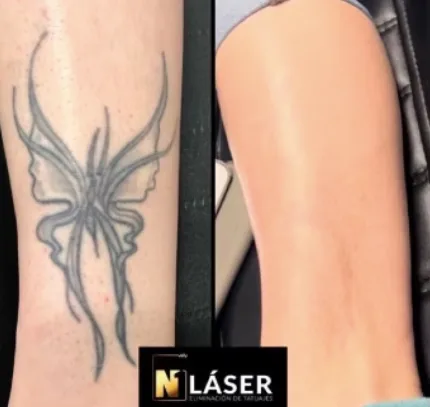 Laser tattoo removal session — Sinkply Madrid × N1 partnership