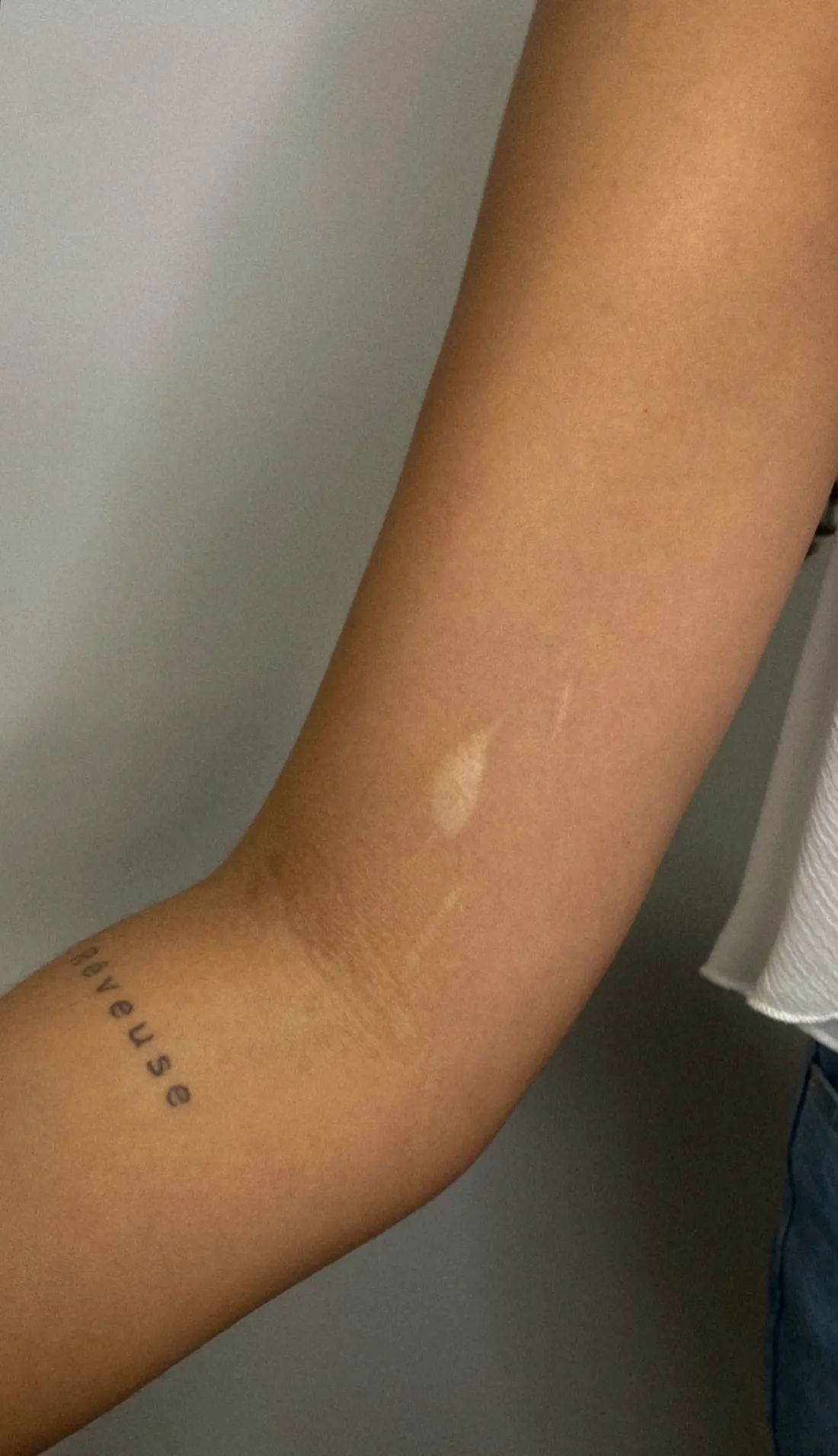 Tatuaje sobre cicatriz — Sinkply Madrid