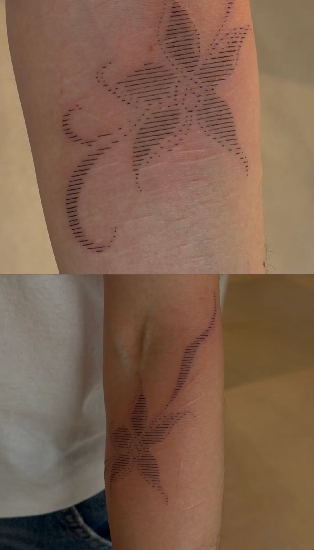 Tatuaje sobre cicatriz — Sinkply Madrid