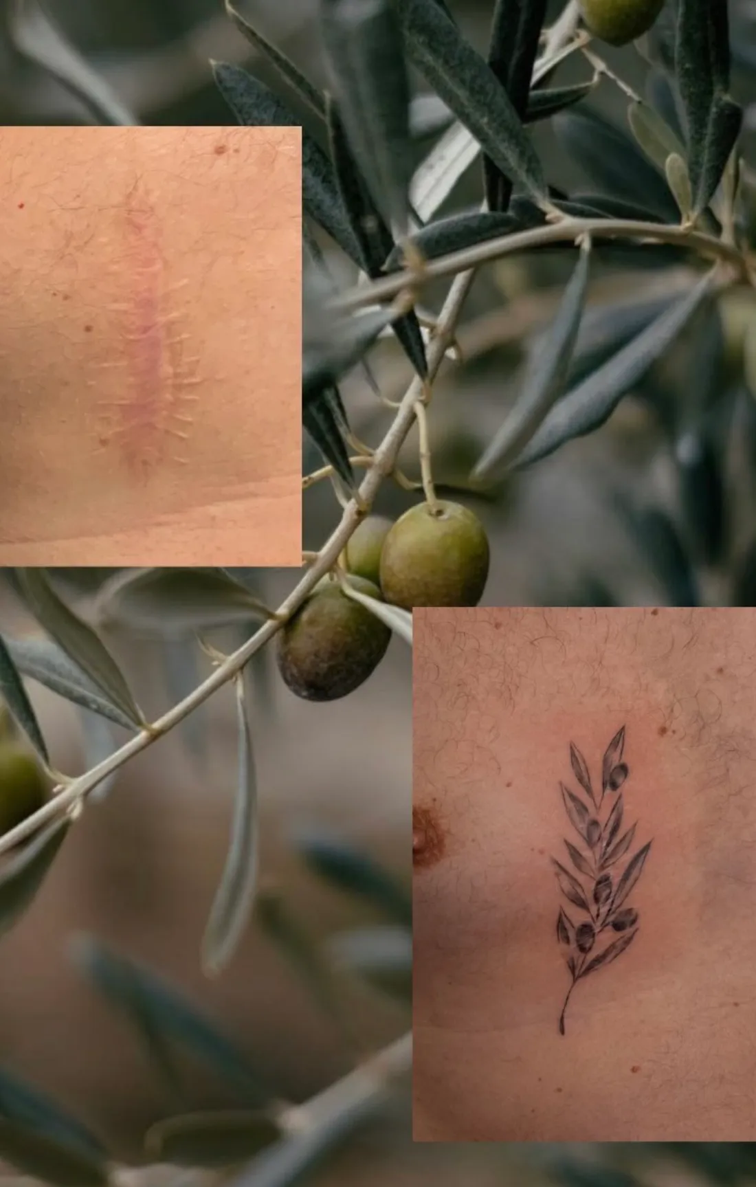 Tatuaje sobre cicatriz — Sinkply Madrid